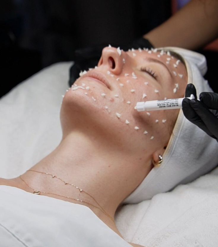 Unlock Radiant Skin with CellStory Liquid Microneedling